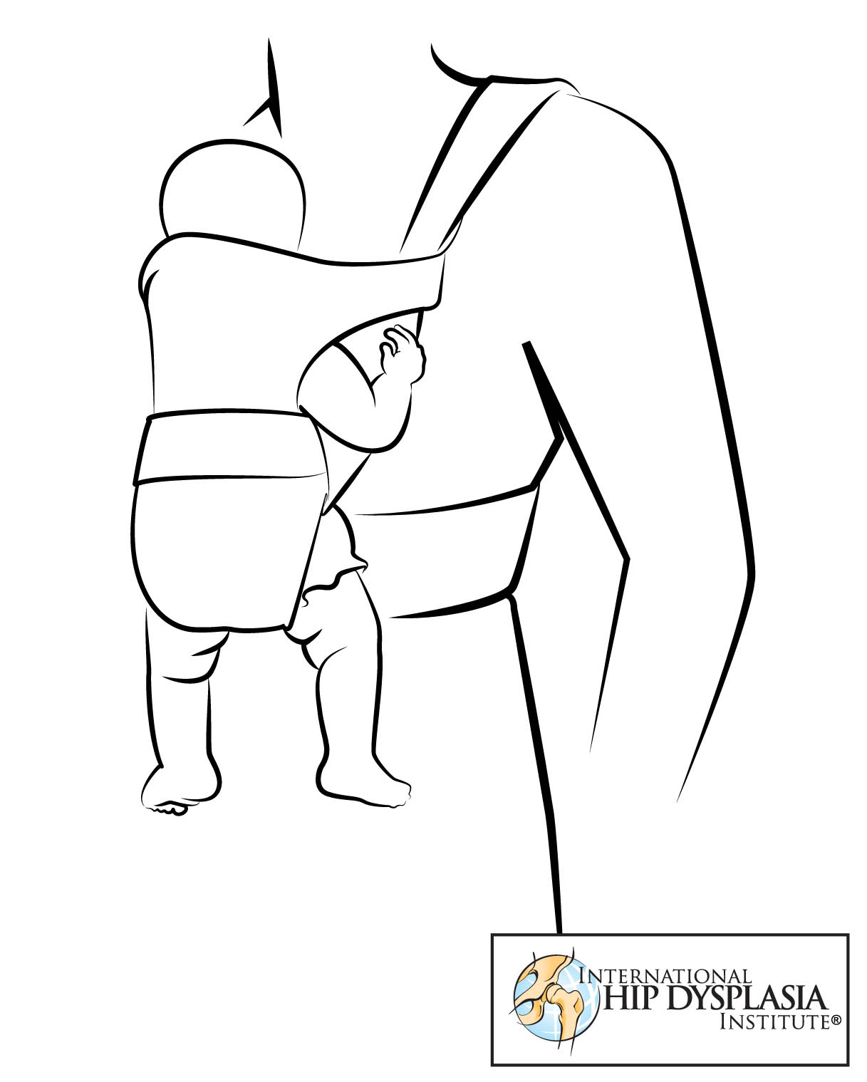 Hip dysplasia lawsuit targets potentially harmful baby carrier design